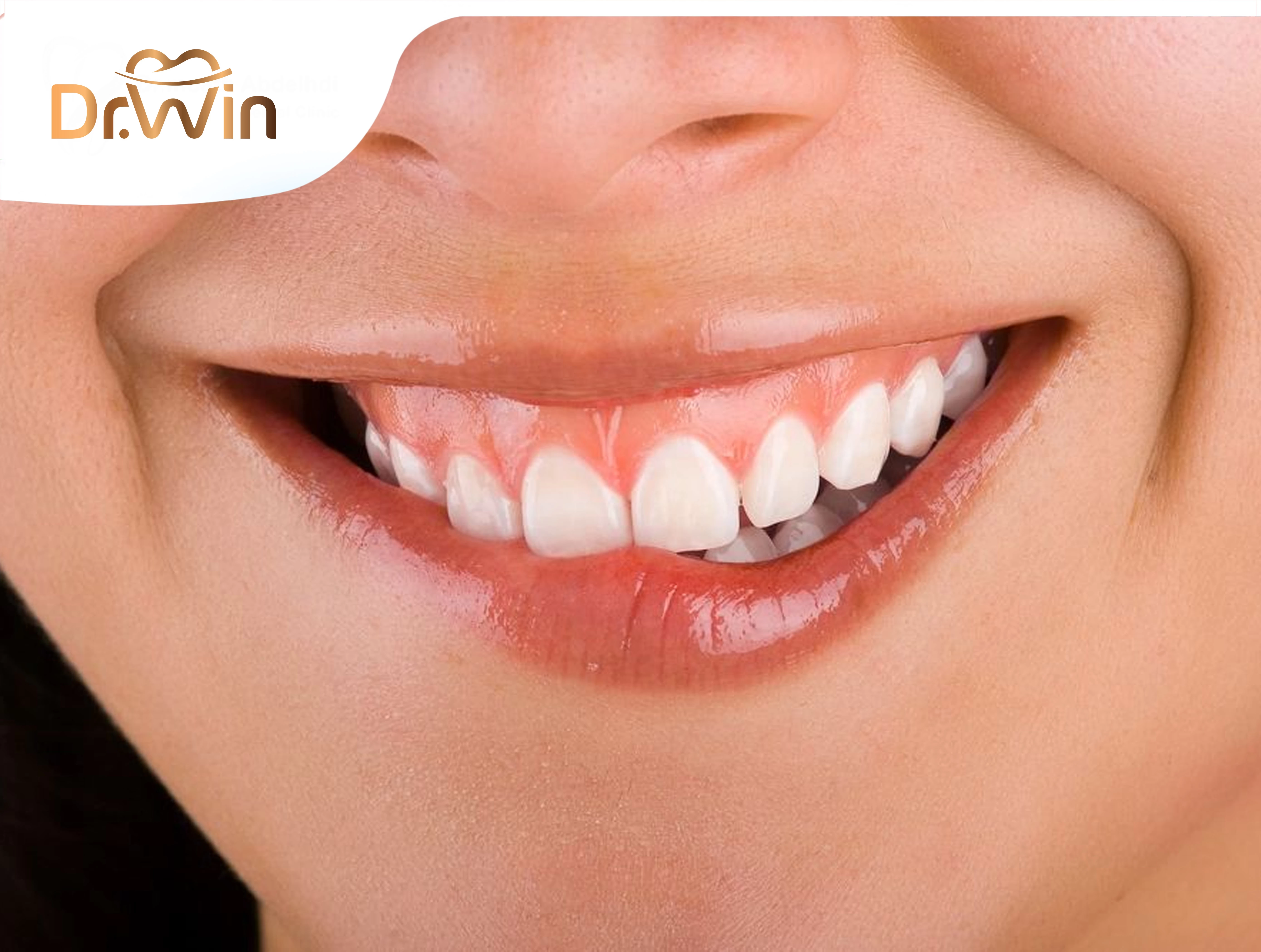 Cắt lợi thẩm mỹ