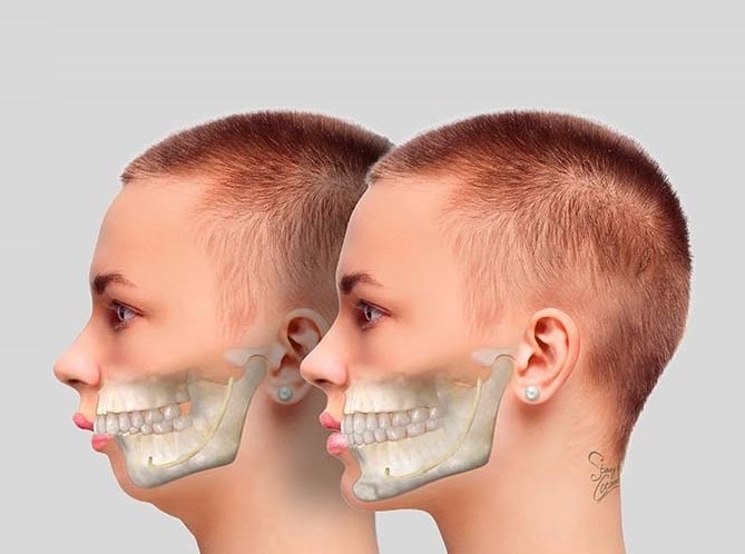 Phẫu thuật hàm hô